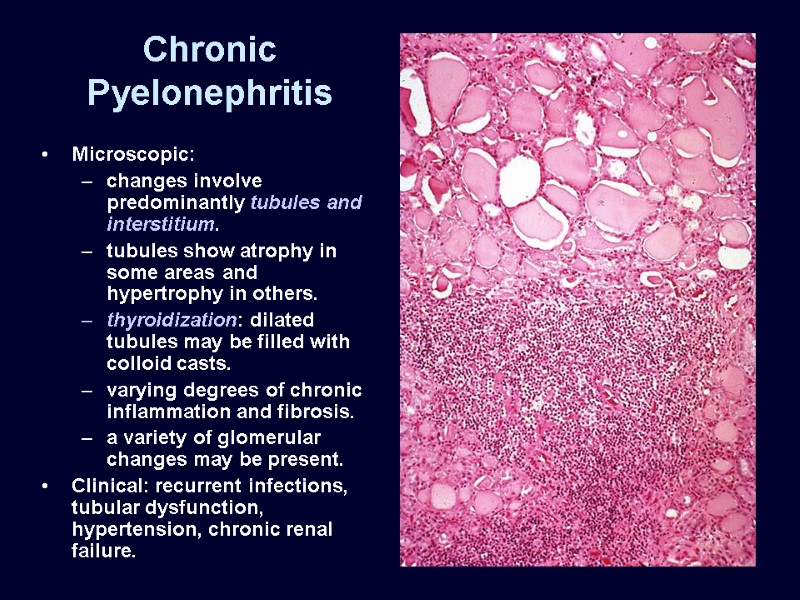 Chronic Pyelonephritis Microscopic: changes involve predominantly tubules and interstitium. tubules show atrophy in some